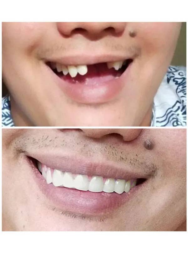 Image of Natural Shade Small Custom Fit Instant Smile Teeth - Before and After Image